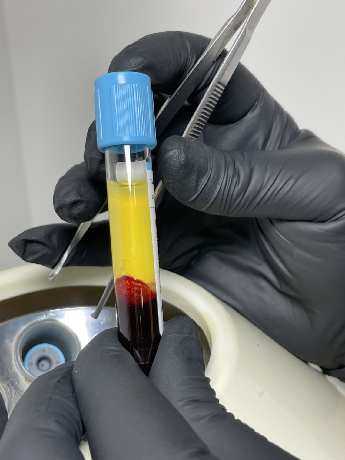 plasma rico en plaquetas